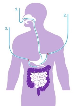Illustratie toedieningsroutes sondevoeding.